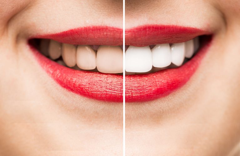 Slider with Before & After Teeth Whitening Marietta GA
