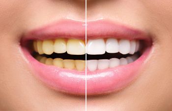 Teeth Whitening Before and After Marietta, GA